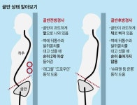 오리궁뎅이 허리통증 봐라 골반전방경사
