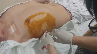 ㅇㅎ)기흉 수술 하는 거 보는 중인데.jpg | 유머 게시판 ㅇㅎ)기흉 수술 하는 거 보는 중인데.jpg | 유머 게시판 | 루리웹