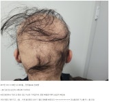 최근 디씨 탈모갤에서 핫하다는 글