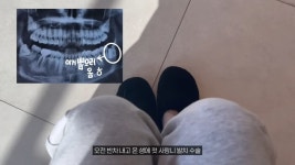 사랑니 뽑고 병원에서 하지 말라는거 다 했다가 나온 결과물