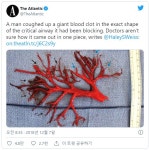 재채기 하다가 나온 온전한 피떡