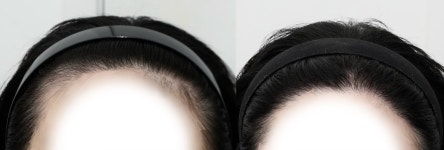 헤어라인 모발이식 1년 1개월 후기 - 뉴헤어모발성형외과의원… | 대다모