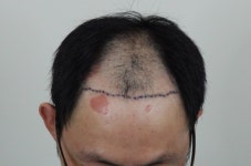 용닥터의원 모발이식포토후기 | 전후사진·후기·생착 경과