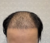 헤이아치 소생기 한달차 - 모제림성형외과의원 모발이식포토… | 대다모