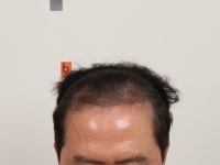 [부산 맘모스헤어라인의원] 부산모발이식 슬릿방식 맘모스 깊은 M자 4개월! - 부산 맘모스헤어라인의원 모발이식포토후기 | 모발이식 후기, 리뷰... 