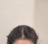 모우다의원 모발이식포토후기 | 전후사진·후기·생착 경과