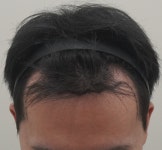 용닥터의원 모발이식포토후기 | 전후사진·후기·생착 경과