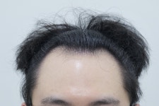 [남성탈모] 연세모에버의원 절개 3500모 벌써 2년 지났네요 | 모발이식 후기, 리뷰, 비용은 대다모!
