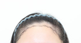 [Mopro Clinic] 신사역 모프로의원 여성헤어라인이식 2600모 1년 경과 후기 - Mopro Clinic Photo Review of Hair... 