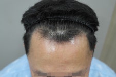 [남성탈모] 부산 에이지의원에서 M자 모발이식 6개월 후기. | 모발이식 후기, 리뷰, 비용은 대다모!