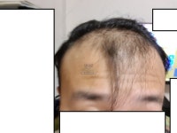 모바른에서 수술한지 두달되기 몇시간전 - 모바른의원 모발이… | 대다모
