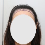 뉴헤어 서울 / 절개 모발이식 재수술 / 1800 모낭 / 1년차 후… | 대다모