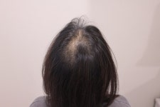 모우다의원 여성 탈모 치료 시작했습니다 | 모발이식 후기, 리뷰, 비용은 대다모!