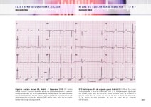 Atlas ecg slideshare