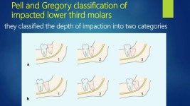 Lec 1 impaction | PPT Lec 1 impaction 
