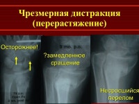 Переломы дистального метаэпифиза лучевой кости slideshare