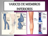 VARICES FISIOPATOLOGIA