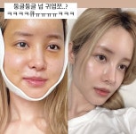 윤곽 수술 유깻잎, 퉁퉁 부은 얼굴에 멍 가득…충격적 비포 애프터 &#039;윤곽 수술&#039; 유깻잎, 퉁퉁 부은 얼굴에 &#039;멍 가득&#039;... 