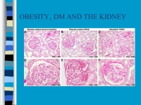 DIABETIC NEPHROPATHY MAY 2013 DR RAMESH B NAIK FRCP. -  ppt download
