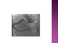  An angiographic tool grading the complexity of coronary artery disease  A semiquantitative visual score that will help us to be... 