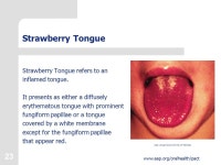 1  Protecting All Children’s Teeth Common Oral Pathology. -  ppt download