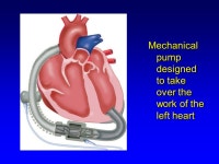 Heart Failure:. Case 1 67 year old man Presented with anterior wall MI in May. Underwent stent placement in the LAD. The other... 