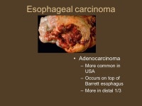 Digestive System Disorders. Overview Gingivitis Heartburn (GERD) Hemorrhoids Cholera Gastric Ulcer Cirrhosis Emesis Gallstones... 