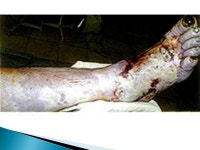 M.d. Shydlovscky A.V.. Necrosis is grow of tissues, or all organ of living organism. -  ppt download