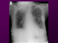 One night at the Foot… 64yo male found down at home… -HR 111 -BP 109/67 -RR 12 -Temp O2 88% -Glucose ppt download