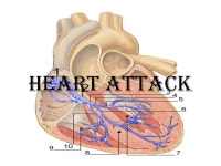 DEFINITION The death of the cells in the area of the heart muscle where blood flow is obstructed can lead to heart attack. FACTS... 