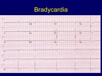 Case Study 2: Symptomatic Bradycardia Robert S. Hoffman, MD Director New York City Poison Center. -  ppt download
