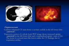 Kh Taalab IMC Role of FDG PET In Characterization of Lung Diseases Cairo Chest 2014 Khalid Muhammad Taalab M.B,B.Ch., M.Sc., M.D.... 