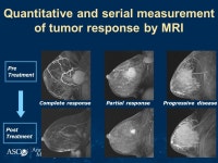 Breast Cancer Molecular Profiles Predict Tumor Response of Neoadjuvant Doxorubicin and Paclitaxel, the I-SPY TRIAL (CALGB /150012... 