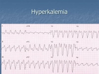 INTERPRETATION of ELECTROCARDIOGRAMS BRIAN D. LE, MD Presbyterian Hospital CIVA. -  ppt download