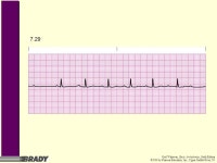 Gail Walraven, Basic Arrhythmias, Sixth Edition ©2006 by Pearson Education, Inc., Upper Saddle River, NJ Chapter 7 Heart Blocks.... 