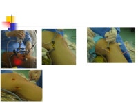 How I Do MCL Repair M. Razi MD;. Anatomy Medial structures MCL POL postero-medial capsular ligament Augmented by dynamic effect... 