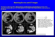 C004 (Subject CG)-Right Carotid Review of the patient diagnosis In vivo image data Tissue matching between in-vivo and ex-vivo... 