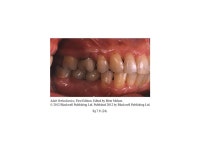 Case 7.6 (1-12) A 53-year-old woman with a nightmare of losing her upper front teeth came for a visit: the patient was not... 