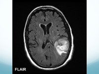 Case Study 19 Craig Horbinski, M.D., Ph.D.. The patient is a 50-year-old white female who was diagnosed with breast cancer in... 