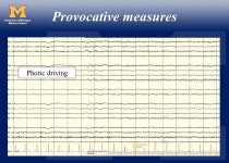 Intro to EEG Nicholas J. Beimer, MD. Lead placement system. -  ppt download