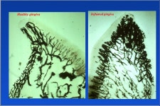 Risk Reduction for Periodontal Disease In addition to more frequent dental visits (treatment/maintenance): Heredity... 