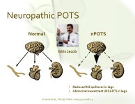 Postural Tachycardia Syndrome (POTS) What? Why? How? Satish R Raj MD MSCI FACC FHRS FRCPC Associate Professor of Cardiac Sciences... 