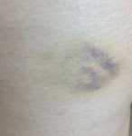 더쿠 - 유산소만 하는데도 멍이 생길수 있나..? (멍사진있음)