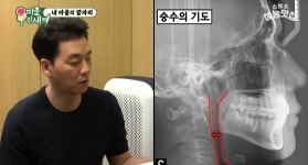 이슈/유머 - [미우새] 깊게 자지 못하고 잠을 자도 잔 거 같지 않거나, 코골이가 심한 이유 중 하나는 기도가 좁기 때문