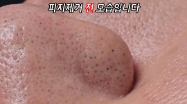 이슈/유머 - 보는 내가 다 시원해지는 블랙헤드 제거 과정.jpgif