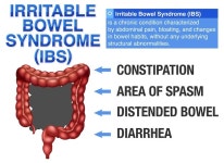 과민성 대장 증후군 IBS 인포그래픽 | 무료 벡터