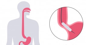 먹는 위풍선·살빼는 전자약…비만 시장 공략 나선 의료기기 | 한국경제 [분석+]먹는 위풍선·살빼는 전자약…비만 시장 공략 나선 의료기기