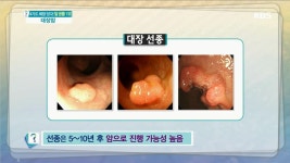 선종은 5-10년후 암으로 진행 가능성 높음 - KBS