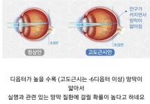 고도근시인 사람들이 주기적으로 안과에 가야하는 이유