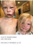 사진흉터주의) 사나운 개에게서 동생을 구한 오빠.jpg - 스퀘어 카테고리